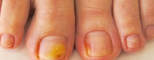 The main symptoms, pictures onychomycosis