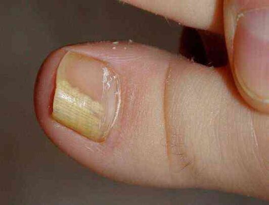 distal form of nail fungus