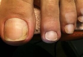Fungus in the big toe