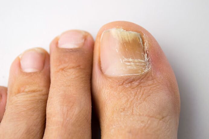 White spots and stripes on the nails - manifestation of onychomycosis