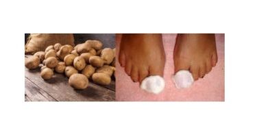 nail fungus treatment potatoes