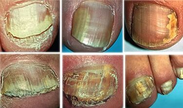Onychomycosis in a severe stage