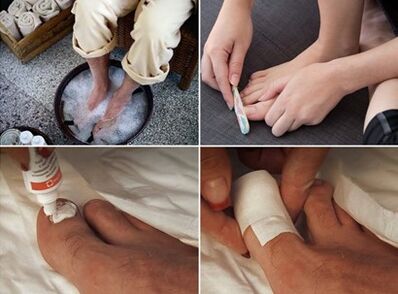 Steam your feet and apply urea cream to the fungal nail