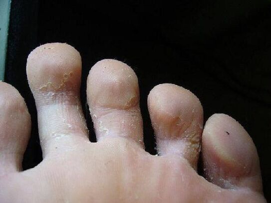 What the fungus looks like on the foot