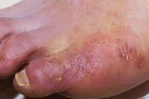 manifestation of a fungal infection on the skin of the feet