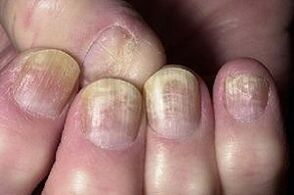 nail changes due to a fungal infection