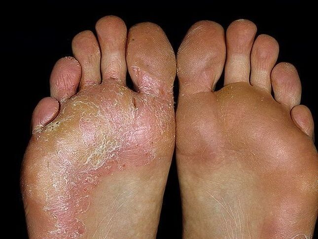 symptoms of fungus in the feet