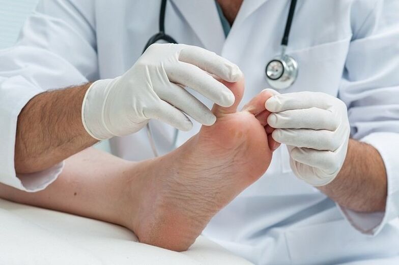 doctor examines foot with fungus