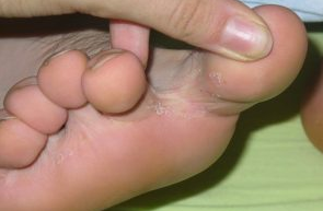 Fungus toes between