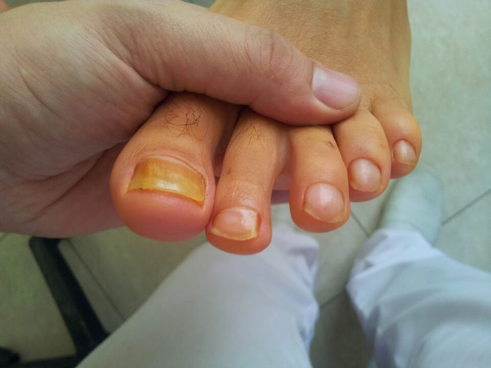 yellow toenails with mushrooms