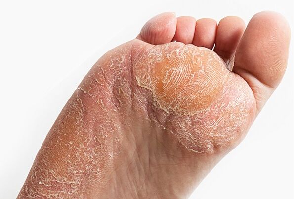 peeling skin when infected with fungus