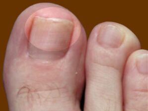 Toenail fungus - a sign for the use of fungicidal drops