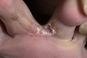 tinea versicolor between the toes