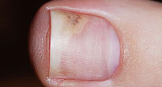 The symptoms in the initial stages of onychomycosis