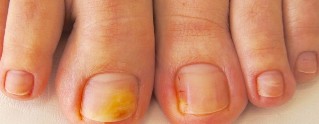 fungal nail symptoms