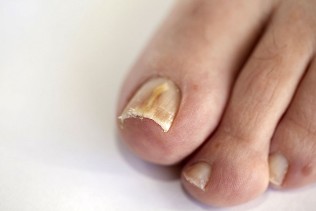 the fungus on the nails