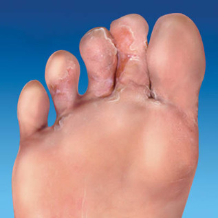 fungal skin feet
