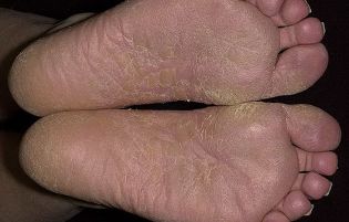 the fungus of the foot